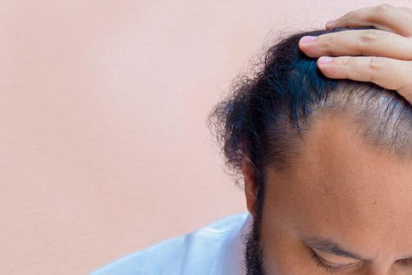 استرس مزمن باعث ریزش مو می گردد