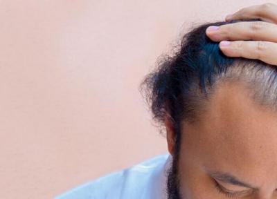 استرس مزمن باعث ریزش مو می گردد